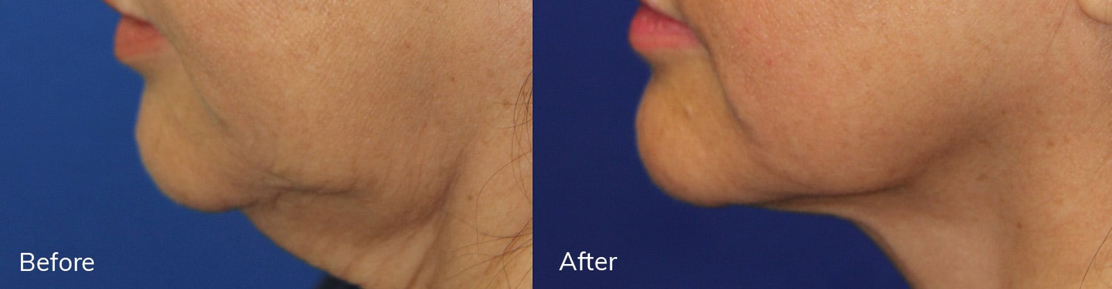 Loose Neck Skin, Double Chin Surgery, Get Rid of Double Chin Fat, SkinFX Canada in Surrey